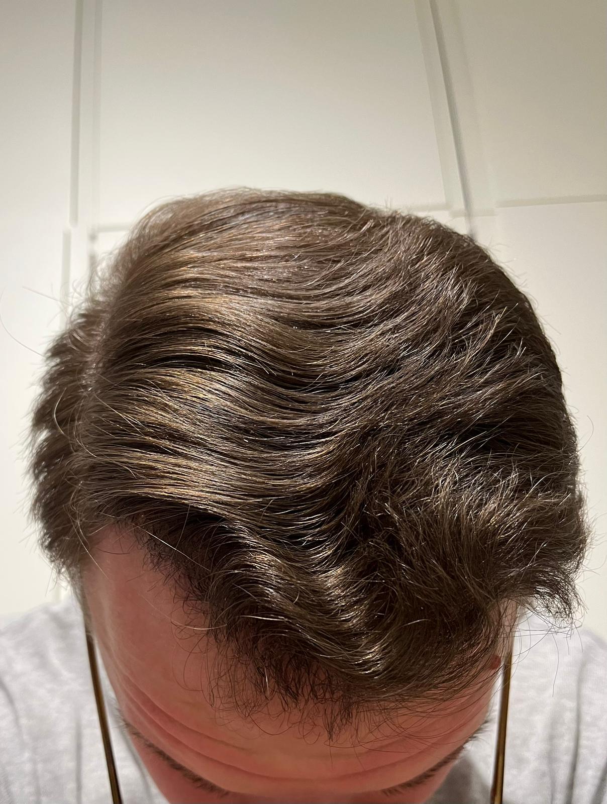 Hair Transplant: An Effective Solution for Hair Loss