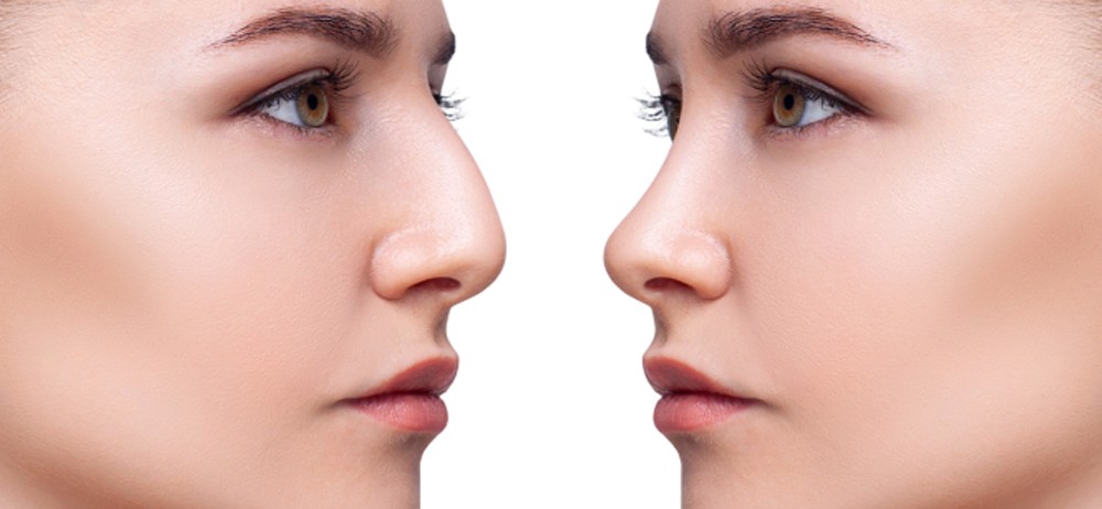 Rhinoplasty: A New Look, A New Confidence